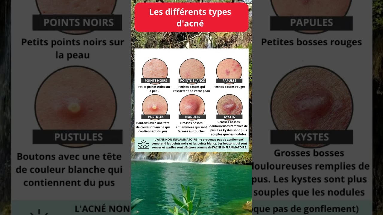 Les différents type d'acné