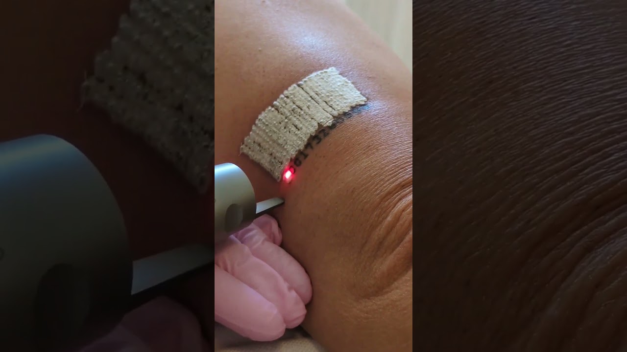 Détatouage laser à Paris | Skin Marceau