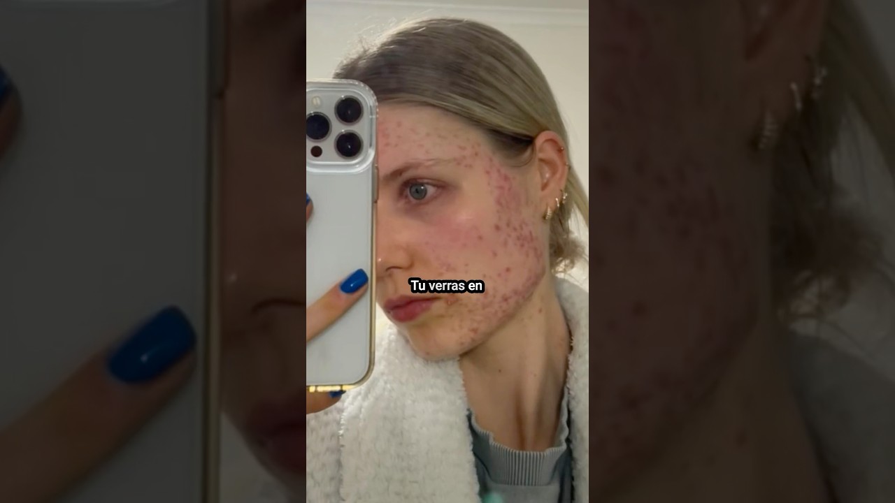 Comment se débarrasser des boutons ‼️ #tips #conseil #cheveux