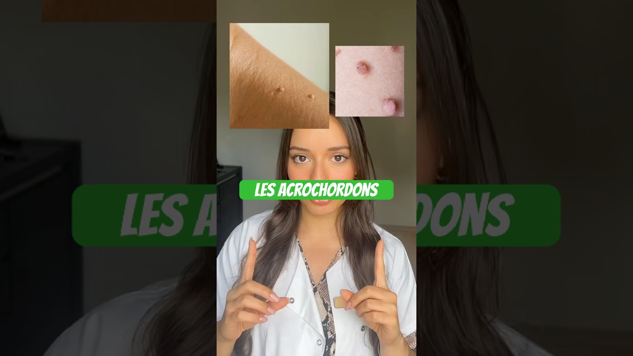 Les acrochordons #santé #peau #acrochordon #skintag #pharmacienne